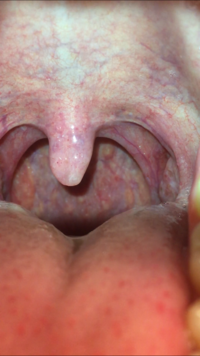 閲覧注意喉について1週間ほど前から喉に違和感があり 口臭が酷く Yahoo 知恵袋