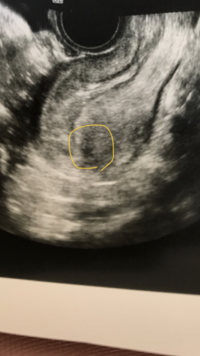 妊娠5週5日で胎嚢が確認されませんでした この黒い部分っぽいけどはっきりと Yahoo 知恵袋