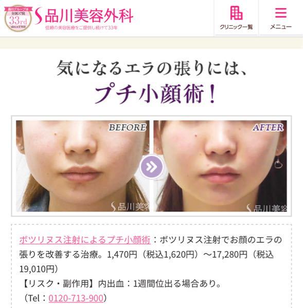 品川美容外科のエラボトックスのこの値段は 両側やった時の値段です Yahoo 知恵袋