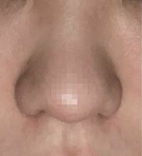鼻がコンプレックスなのですが、 これはニンニク鼻ですか？それともだんご鼻ですか？
自分にはふたつが合わさった鼻に感じます