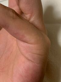 小指が痒くて 気づいたら指の付け根の方にぶつぶつができていました 画 Yahoo 知恵袋