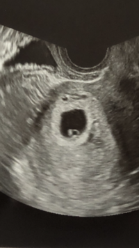 6週3日のエコー写真です このエコー写真で胎芽は確認できますか 私と Yahoo 知恵袋