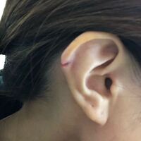 ピアスで耳が裂けるのはよくあることですか さっき知恵袋で 耳が裂けた人の質問 Yahoo 知恵袋