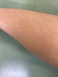 至急 あざの隠し方明日体育祭があるのですが私は首に大きな痣が Yahoo 知恵袋