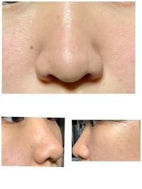 整形で口を大きくすることは可能ですか 口が小さいのがコンプレックスで Yahoo 知恵袋