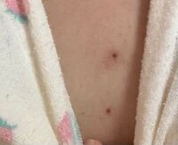 胸ニキビをぎゅーってつまんだら 紫色になってしまいました 一生跡残りま Yahoo 知恵袋