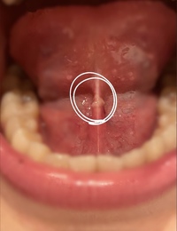 お見苦しい画像失礼します舌の裏側の舌小帯 采状ひだ に白いできも Yahoo 知恵袋