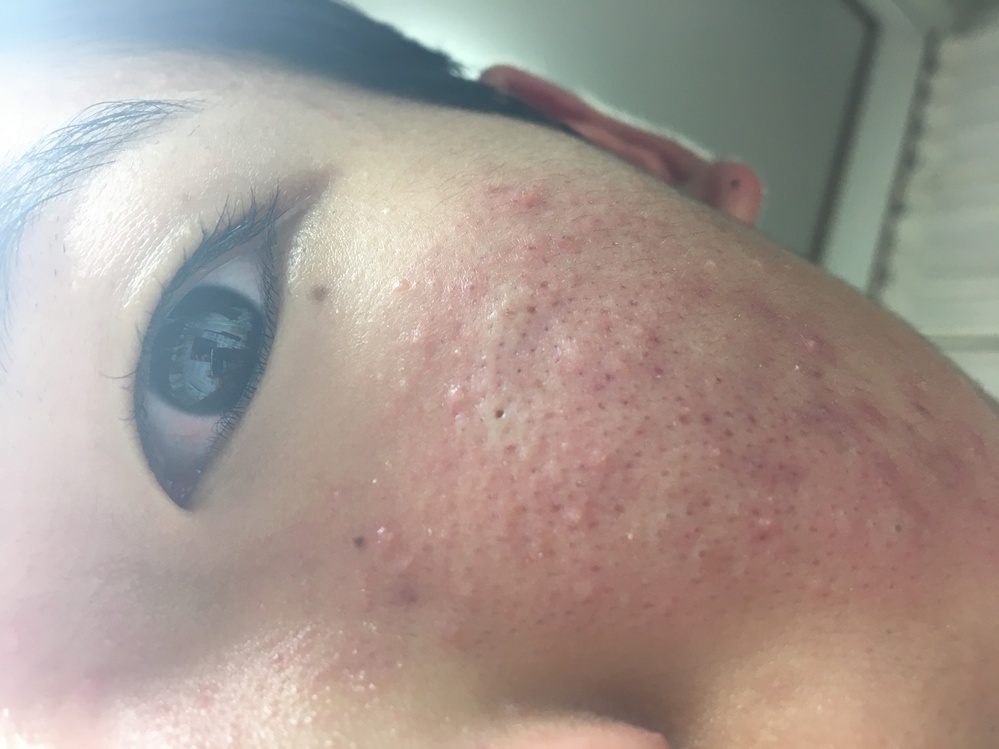 ニキビケア すべての質問 Yahoo 知恵袋