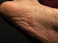 汚い写真すみません 足の裏の中央に水泡の集合体みたいなものが出来ました 少 Yahoo 知恵袋