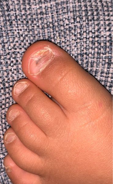 内出血 血豆 に関するq A Yahoo 知恵袋