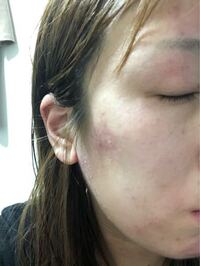 質問お願いします 最近になって顔の肌荒れが本当にひどいです 何が原因 Yahoo 知恵袋