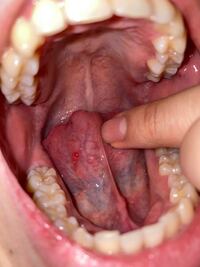 閲覧注意舌が痛く炎症箇所を探していたのですが 見つけたところ舌の裏に痛みの Yahoo 知恵袋