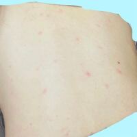 こんな湿疹が背中 お腹腰周り太もも付け根あたりに沢山できています Yahoo 知恵袋