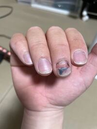 2 3ヶ月前に爪が内出血してしまいました 今日 爪の一部が Yahoo 知恵袋