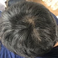 大学生です 朝つむじが画像のように割れてしまうのですが これは毛の流れのせ Yahoo 知恵袋