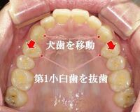 歯並びは悪くないのですが小さい頃から口呼吸で 今は鼻呼吸 口ゴボ みたいに Yahoo 知恵袋