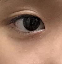 一重から平行二重になりました 1ヶ月はこの状態です 両親は完全な一重で姉は大 Yahoo 知恵袋