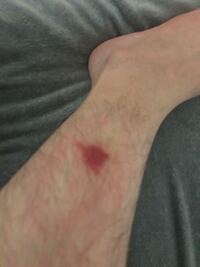 蚊に刺されたような痒みがある場所がいつもと違く凄く赤くなってるん Yahoo 知恵袋