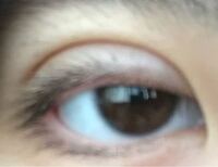 埋没して2日後です 一向に腫れが引きません 金曜日から学校 Yahoo 知恵袋