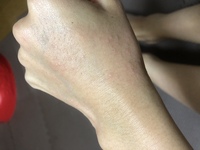 数日前から手の甲と足の甲にのみ湿疹 蕁麻疹 の様な痒みがあるブツブツ Yahoo 知恵袋