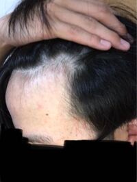 高校生です 最近m字ハゲに気づいてかなり悩んでいます ブリーチ2回 黒染め Yahoo 知恵袋