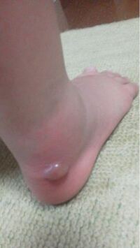 子供が虫に刺されました 次の日に水膨れになり痛がっています 今では痛 Yahoo 知恵袋