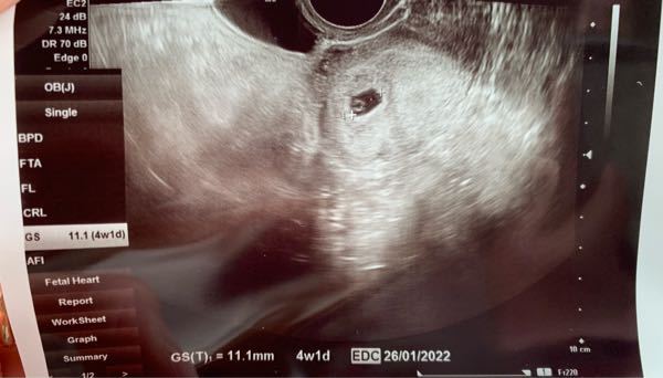 今日胎嚢が確認できました ただ 今朝から茶色いおりもの 出血があ Yahoo 知恵袋