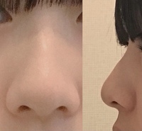 昔から丸い鼻先と大きい小鼻が悩みで整形を考えています 小鼻縮小は Yahoo 知恵袋