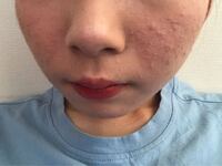 最近肌荒れがやばいです 高校生になって化粧を毎日している Yahoo 知恵袋