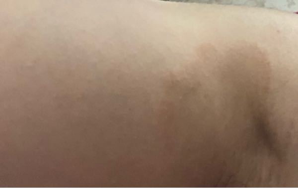 皮膚の病気 アトピー 解決済みの質問 Yahoo 知恵袋