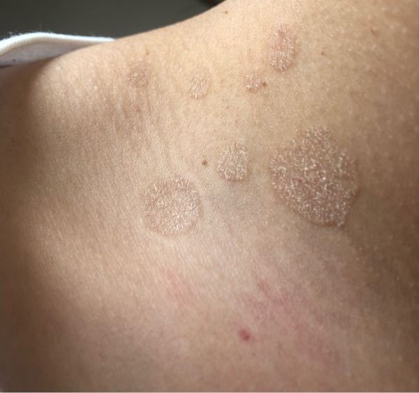 これは癜風でしょうか？ - 1週間ほど前から鎖骨の上あたりにでき、最初 