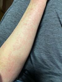 入浴後写真のような発疹が出ることが多くなりました アトピー持ちでたまに蕁麻 Yahoo 知恵袋