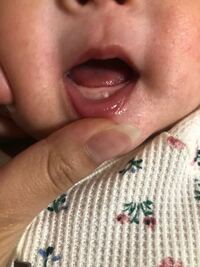 歯茎 白い 赤ちゃん 赤ちゃんの歯茎にできる白いブツブツの正体。原因や対処法について