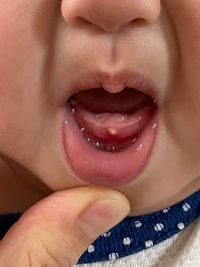 歯並びについて7ヶ月の娘に乳歯が生えてきました 歯茎外側の Yahoo 知恵袋