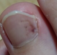 約１週間前に右足の親指爪に 黒い斑点のようなものが付着してる事に Yahoo 知恵袋