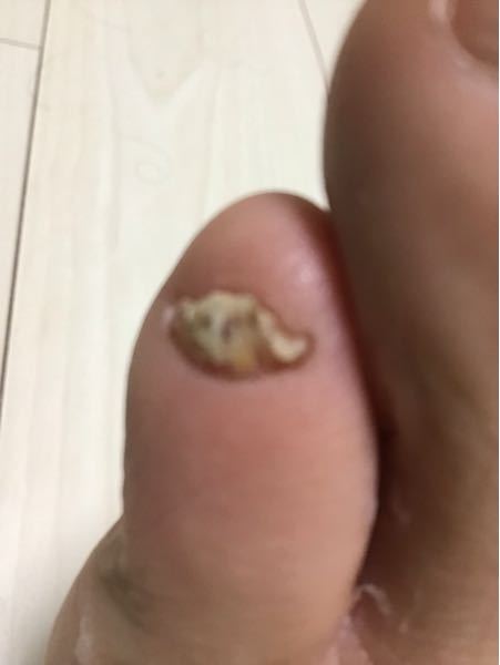 水虫 解決済みの質問 Yahoo 知恵袋