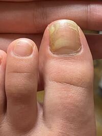 両足の親指の爪が他の指に比べ黄色く まだらに白い部分があります これ Yahoo 知恵袋