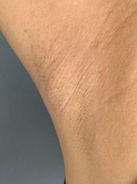 10代ですが脇がとても汚いです どうしたら綺麗になりますか Yahoo 知恵袋