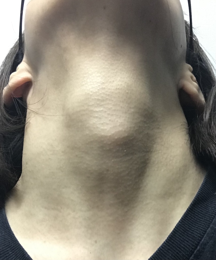 最近、喉仏付近が目立つようになった気がするのですが、甲状腺が腫れ 