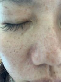 ウズラのたまごの様なシミを消す方法を教えて下さい 美容皮膚 Yahoo 知恵袋