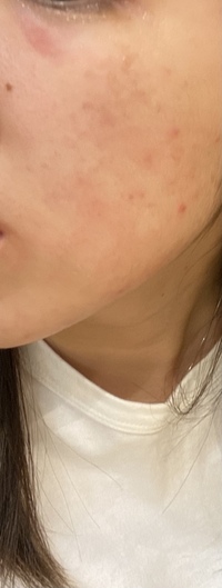 片方の頬だけすごい肌荒れが首まできてて顔が痛くて仕方ないです Yahoo 知恵袋