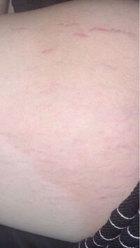 ダイエット マッサージ 肉割れについてです 太もものマッ Yahoo 知恵袋