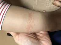 生後4ヶ月の赤ちゃんです 足のすねより下 足首付近 に 湿疹ができたの Yahoo 知恵袋