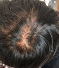 中3男子です 生まれつき髪が細いんですけどこれはやばいですか 最近気 Yahoo 知恵袋