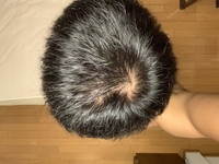 つむじは２つあります 母型の父が髪が薄毛でした 将来自分も薄毛に Yahoo 知恵袋