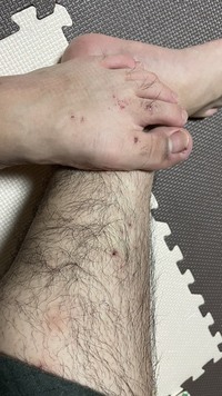 お肌にぶつぶつができて かゆいがとてもあります このぶつぶつはなにですか Yahoo 知恵袋