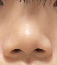 豚鼻がコンプレックスで仕方ありません 私の鼻は 今までこれ以 Yahoo 知恵袋