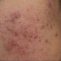 閲覧注意ニキビに悩んでいます ニキビでき始めてからとにかく陰気な性格になり Yahoo 知恵袋