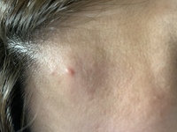 これ吹き出物 ニキビですか 生理前になると顎やおでこ付近によく赤くポチッと Yahoo 知恵袋