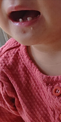 １歳６ヶ月の娘がいる母です 娘は下の真ん中の歯が2本ありません Yahoo 知恵袋
